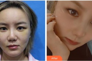 赤峰现代妇产医院医疗美容科王志坚整形价格表附鼻部综合案例展示