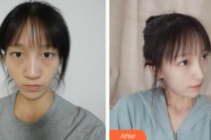 长春海峡美容医院孟宪勇整形价格表附耳软骨复合隆鼻案例展示