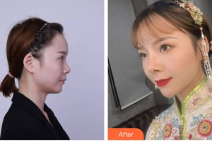 新疆张瑞红医疗美容诊所冯勋兰整形价格表附鼻部手术案例展示