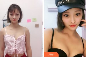 大庆龙南医疗整形美容诊所赵金凤整形价格表附隆胸手术案例展示