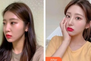 松原齐飞美容外科门诊部周春玲整形价格表附鼻部综合案例展示