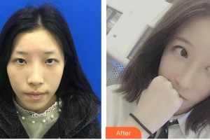 陕西省友谊医院医学整形科张永整形价格表附眼部综合案例展示