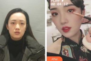 武警广西总队医院医学整形美容中心赵福德整形价格表附热玛吉案例展示