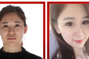 武警广西总队医院医学整形美容中心张潮整形价格表附埋线提升案例展示