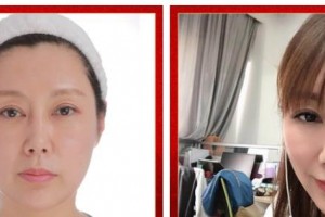 武警广西总队医院医学整形美容中心王朝生 教授整形价格表附埋线提升案例展示