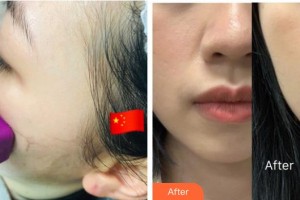 武警广西总队医院医学整形美容中心张树芳 整形价格表附热玛吉案例展示