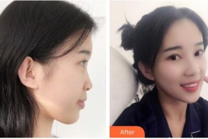 广西东方整形美容医院仇侃敏整形价格表附鼻部综合案例展示