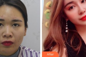 广西医科大学美容整形中心周翔整形价格表附耳软骨复合隆鼻案例展示