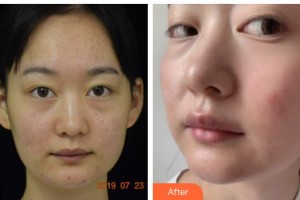 广西医科大学美容整形中心韦洁整形价格表附去痘印痘坑案例展示
