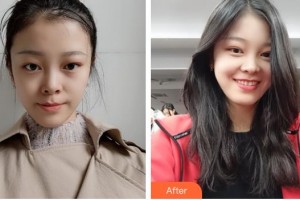 广西爱思特整形外科医院肖翔辕整形价格表附微针美肤案例展示