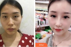 广西爱思特整形外科医院李俊明整形价格表附鼻部综合案例展示