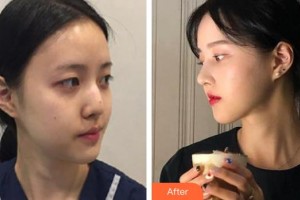 广西壮族自治区人民医院整形美容中心黄欣整形价格表附鼻部综合案例展示