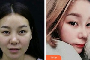 武警广西总队医院医学整形美容中心孙周映整形价格表附鼻部综合案例展示