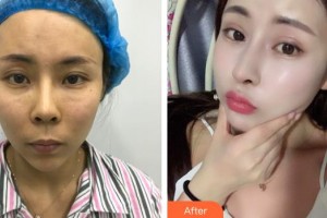 武警广西总队医院医学整形美容中心陈笑整形价格表附鼻修复案例展示