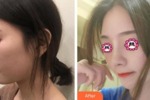 武警广西总队医院医学整形美容中心尹熙根整形价格表附肋软骨隆鼻案例展示