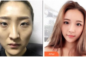 武警广西总队医院医学整形美容中心朴宰久整形价格表附假体隆鼻案例展示