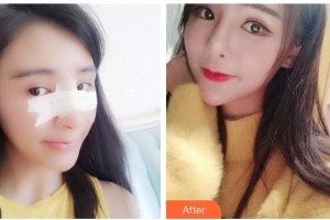 武警广西总队医院医学整形美容中心玉宝光 整形价格表附耳软骨复合隆鼻案例展示