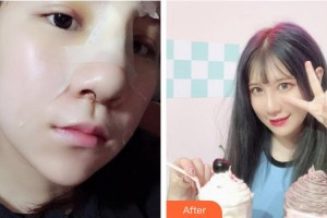 广西民族医院医学美容科杨竟忠整形价格表附鼻部综合案例展示