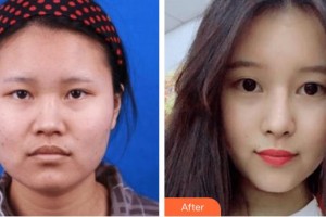 广西中医院第一附属医院美肤激光整形美容科李红阳整形价格表附鼻部综合案例展示