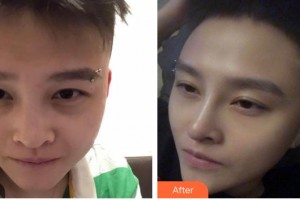 广西中医院第一附属医院美肤激光整形美容科林辉整形价格表附鼻部综合案例展示