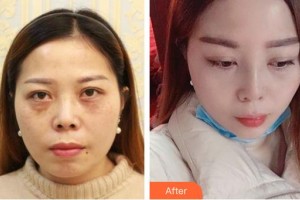 广西东方整形美容医院周忆芬整形价格表附鼻部综合案例展示