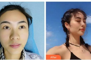 广西东方整形美容医院刘和平整形价格表附耳软骨复合隆鼻案例展示