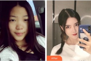 广西中医院第一附属医院美肤激光整形美容科梁桂枝整形价格表附鼻部综合案例展示