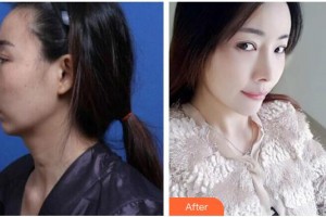 广西医科大学第一附属医院整形美容科黄安林整形价格表附鼻修复案例展示