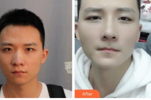 广西医科大学第一附属医院整形美容科王润秀整形价格表附鼻部综合案例展示