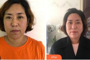 广西中医药大学附属瑞康医院整形美容中心李莉整形价格表附切开双眼皮案例展示