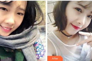 广西中医药大学附属瑞康医院整形美容中心林忠整形价格表附切开双眼皮案例展示