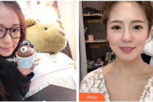 广西东方整形美容医院卢静香整形价格表附金属托槽矫正案例展示