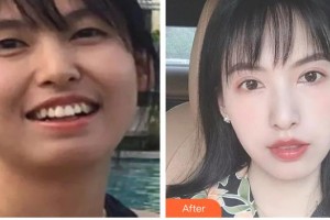 广西中医药大学附属瑞康医院整形美容中心吴伟民整形价格表附金属托槽矫正案例展示