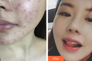 武警广西总队医院医学整形美容中心董小飞整形价格表附红蓝光祛痘案例展示