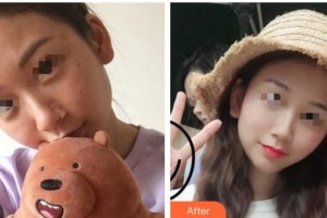 广西东方整形美容医院陈柳艺整形价格表附清洁祛痘案例展示