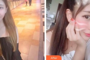 广西东方整形美容医院龙海波整形价格表附彩光嫩肤案例展示