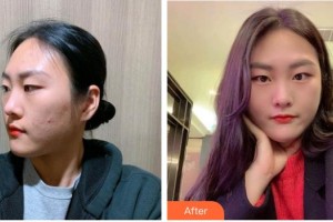 广西医科大学第一附属医院整形美容科蒙诚跃整形价格表附清洁祛痘案例展示