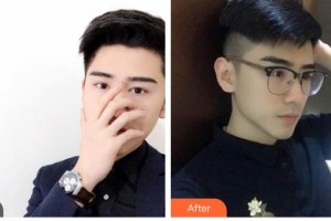 武警广西总队医院医学整形美容中心向宏伟整形价格表附鼻部综合案例展示