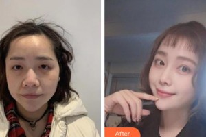 广西东方整形美容医院于晓倩整形价格表附埋线提升案例展示