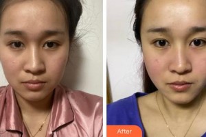 广西帝医医疗美容门诊部林山整形价格表附外切祛眼袋案例展示