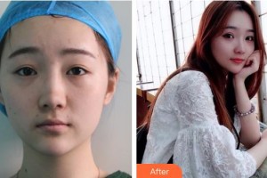 广西广丽医疗美容医院刘明整形价格表附定点双眼皮案例展示