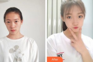 广西爱思特整形外科医院韦强整形价格表附眼部综合案例展示