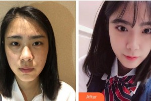 柳州红十字会眼科医院阳桥生整形价格表附切开双眼皮案例展示