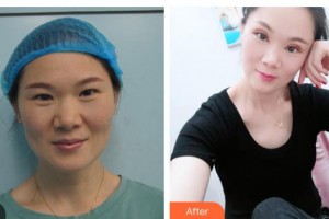 柳州爱尔眼科医院黄明海整形价格表附切开双眼皮案例展示