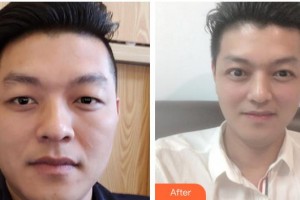 柳州爱尔眼科医院陈振文整形价格表附切开双眼皮案例展示