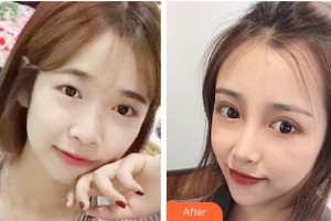 柳州红十字会眼科医院荣德彦整形价格表附切开双眼皮案例展示