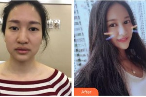 柳州红十字会眼科医院韦乐强整形价格表附切开双眼皮案例展示
