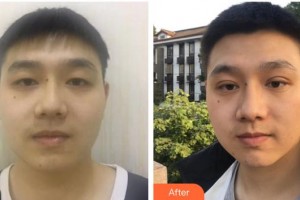 柳州红十字会眼科医院王欢燕整形价格表附切开双眼皮案例展示