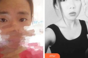 柳州市柳铁中心医院烧伤整形外科林嘉昕整形价格表附切开双眼皮案例展示