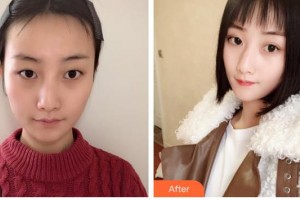 柳州市中医医院眼科宁作莲住院医师整形价格表附定点双眼皮案例展示